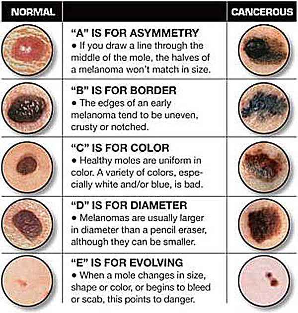 Common Moles, Dysplastic Nevi, and Risk of Melanoma ...