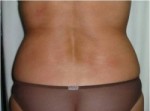 Exilis Ultra