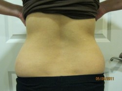 Exilis Ultra