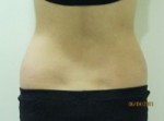 Exilis Ultra