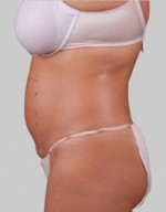 Exilis Ultra