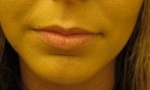 Lip Augmentation