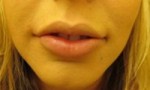 Lip Augmentation