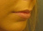 Lip Augmentation