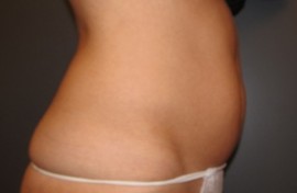 Coolsculpting