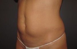 Coolsculpting