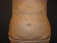 Coolsculpting