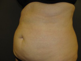 Coolsculpting