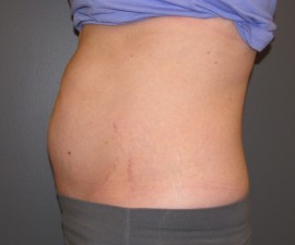 Coolsculpting