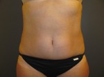 Coolsculpting