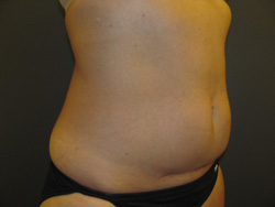 Coolsculpting