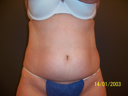 Coolsculpting