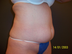 Coolsculpting