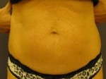 Coolsculpting