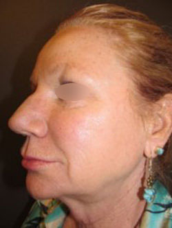 Restylane
