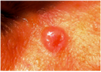 Basal Cell Carcinoma