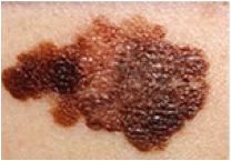 Melanoma