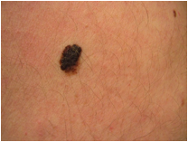 Atypical (Dysplastic) Mole