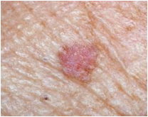 Actinic Keratosis