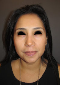 Chemical Peels