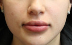 Lip Augmentation