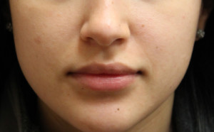 Lip Augmentation