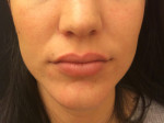 Lip Augmentation