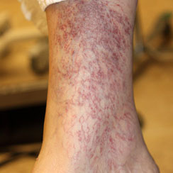 Sclerotherapy