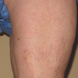 Sclerotherapy