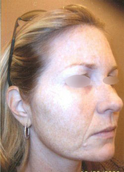 Intense Pulsed Light