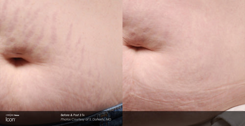 Stretch Mark Treatment