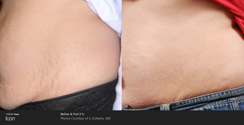 Stretch Mark Treatment