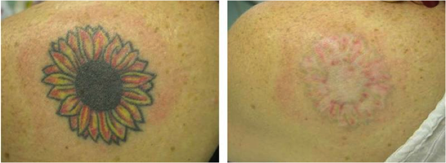 Tattoo Removal