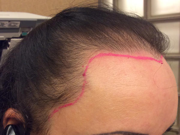 Neograft Follicular Unit Grafts Newark | Hair Restoration Wilmington Neograft Follicular Unit Grafts Newark | Hair Restoration Wilmington