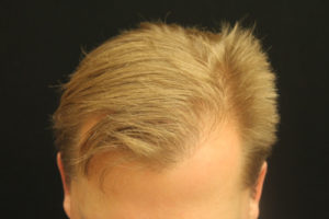 Neograft Hair transplantation