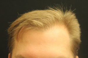 Neograft Hair transplantation