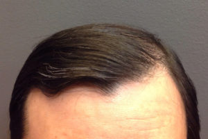 Neograft Hair transplantation