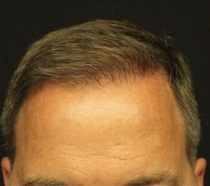 Neograft Hair transplantation