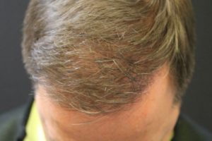 Neograft Hair transplantation