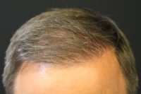 Neograft Hair transplantation