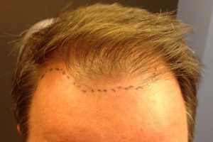 Neograft Hair transplantation