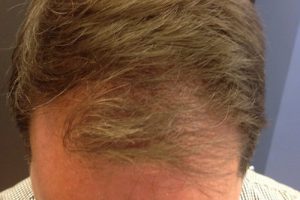 Neograft Hair transplantation