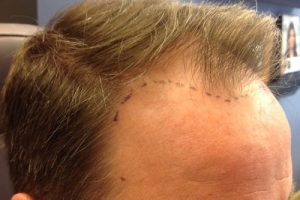 Neograft Hair transplantation