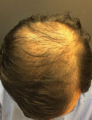 Neograft Hair transplantation