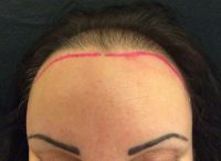 Neograft Hair transplantation