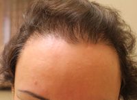 Neograft Hair transplantation