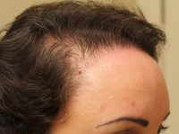 Neograft Hair transplantation