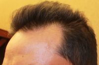 Neograft Hair transplantation