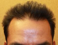 Neograft Hair transplantation