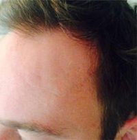 Neograft Hair transplantation